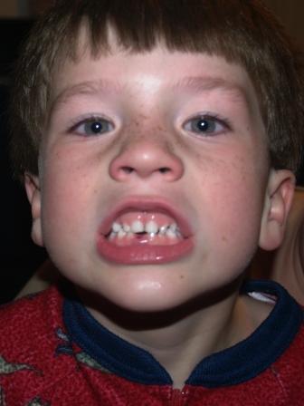 LukeTooth3